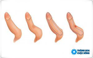 Bài tập cho cậu nhỏ bị cong