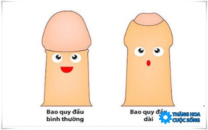 bao quy đầu bị dài