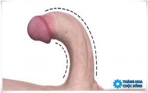 Làm sao cho cậu nhỏ hết cong tại nhà