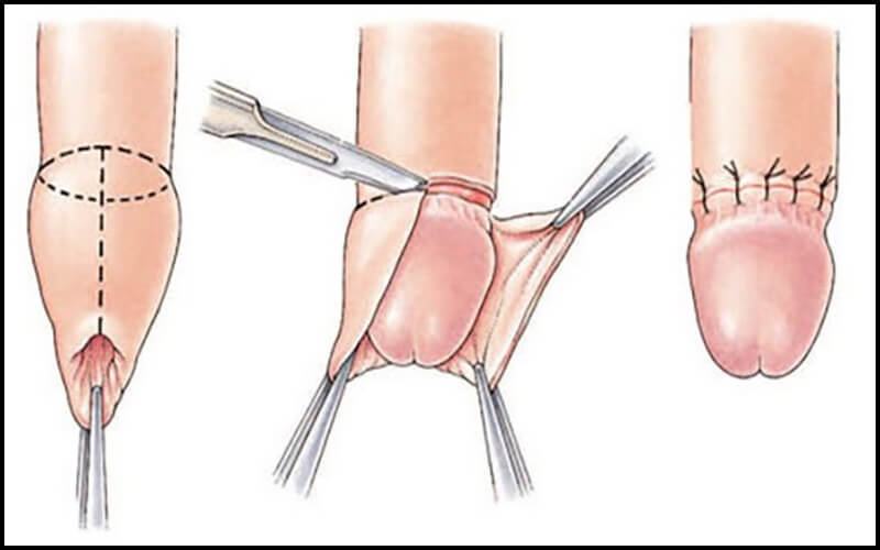 Tiểu phẫu cắt bao quy đầu