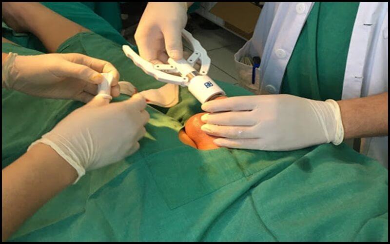 phẫu thuật cắt bao quy đầu