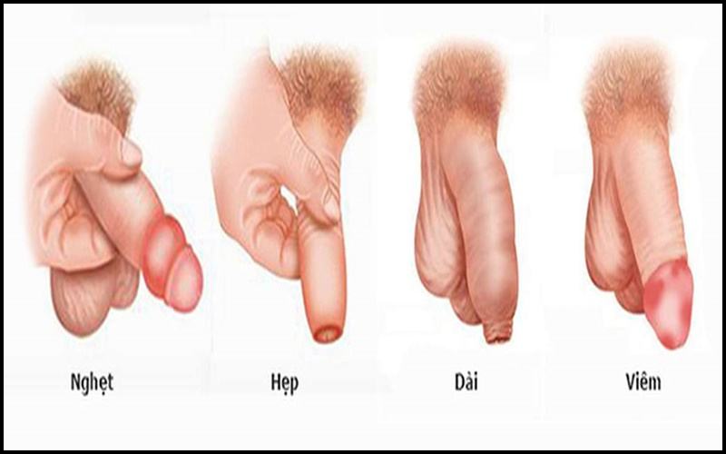 Nghẹt bao quy đầu