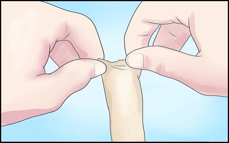 Lột bao quy đầu