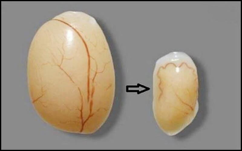 Teo tinh hoàn là gì