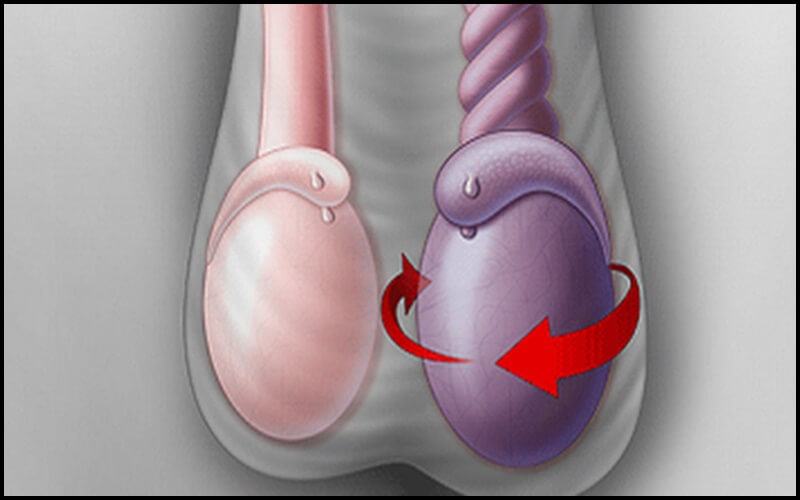 Tinh hoàn bên lớn bên bé