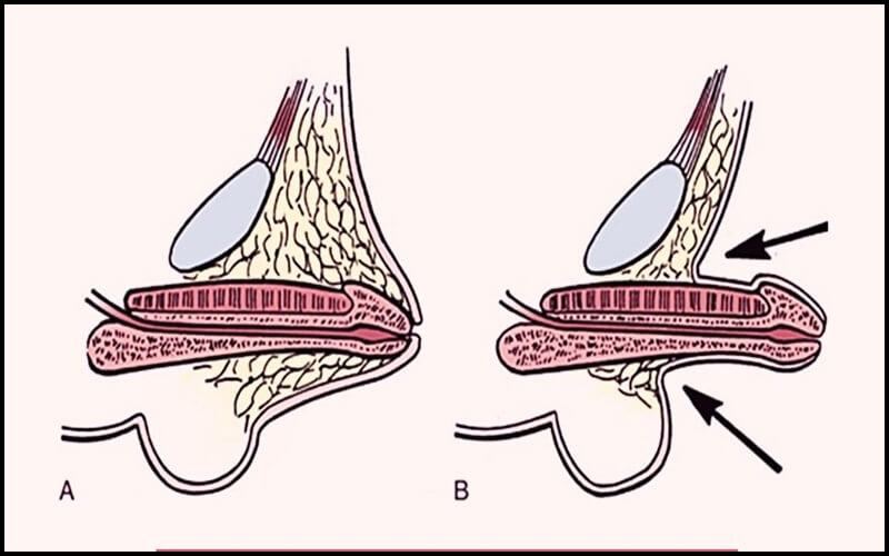 Hiện tượng thụt dương ở người lớn