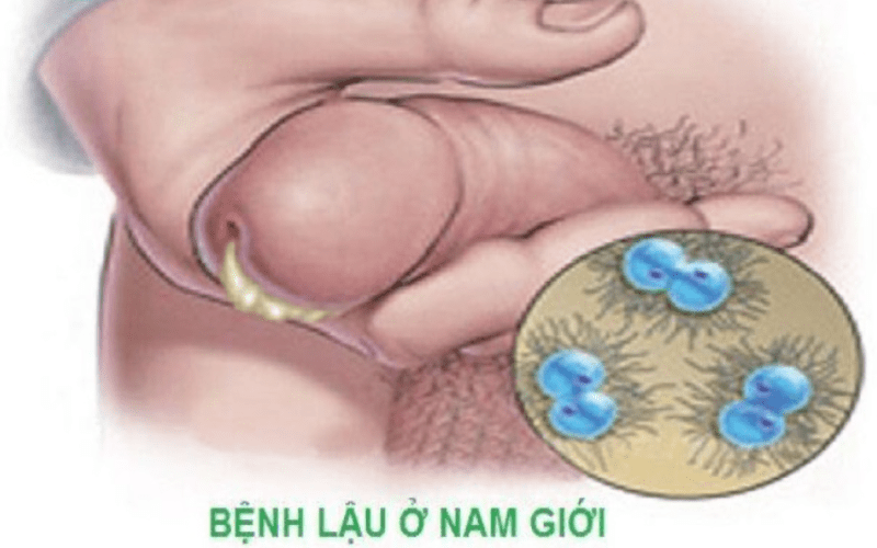 Dương vật có mùi hôi do bệnh lậu