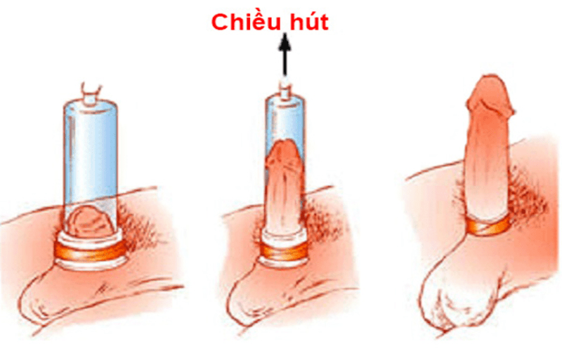 bơm hút chân không tăng kích thước dương vật