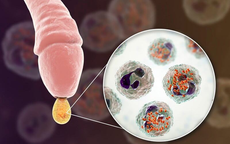 viem-bao-quy-dau-co-tu-khoi-khong