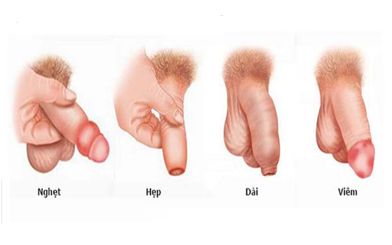các bệnh về bao quy đầu làm đau rát khi làm tình