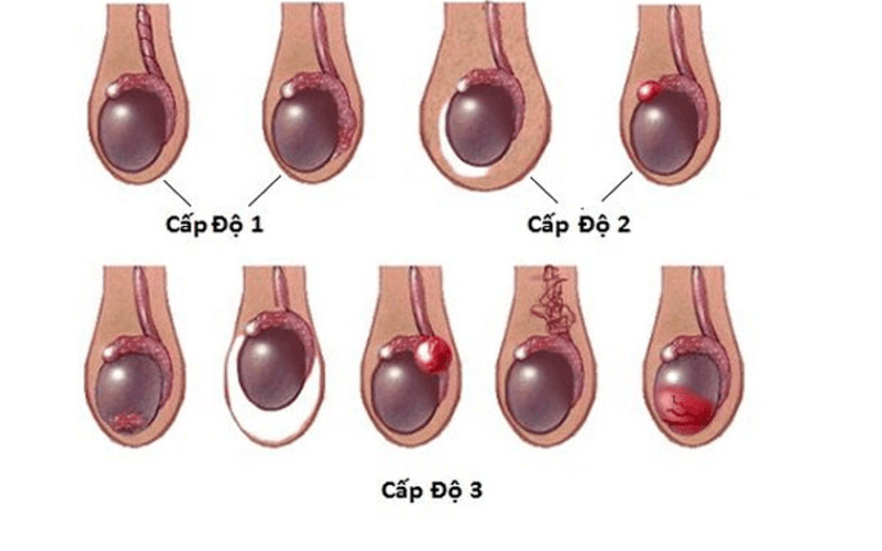 gian-tinh-mach-tinh-do-1-can-chua-khong-1