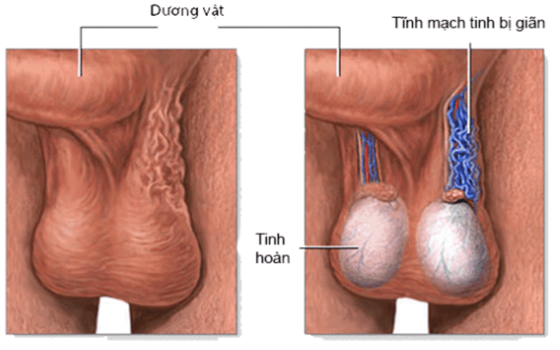 gian-tinh-mach-thung-tinh