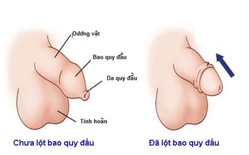 Hướng dẫn cách lột bao quy đầu tại nhà nhanh, không đau