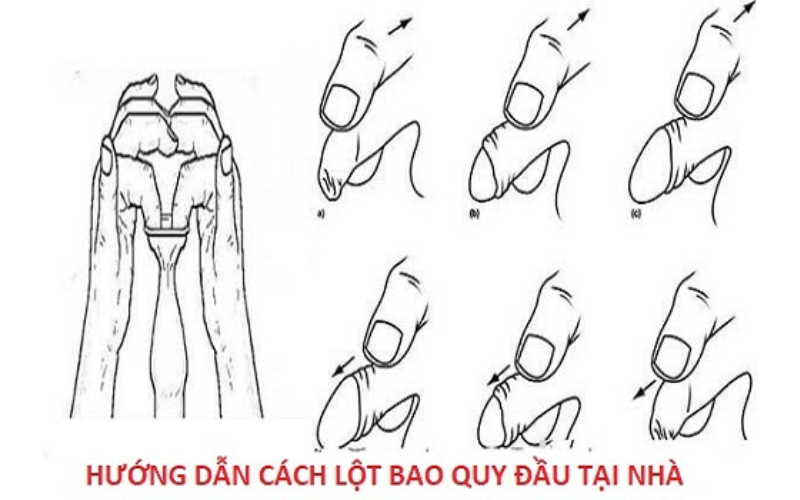 cách lột bao quy đầu tại nhà