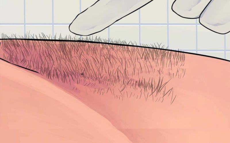 triệt lông vùng kín nam