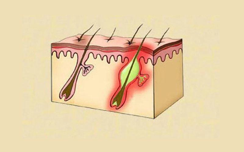 có nên tỉa lông vùng kín nam không