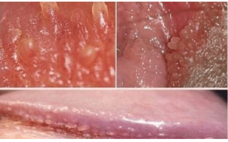 Gai sinh dục nữ xuất hiện khi nào