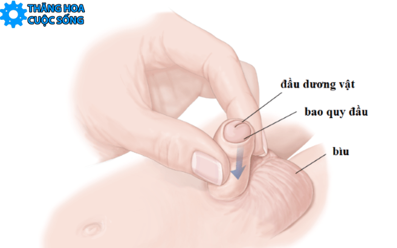 bệnh bao quy đầu hẹp