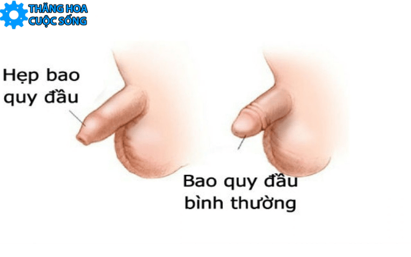 Bị hẹp bao quy đầu