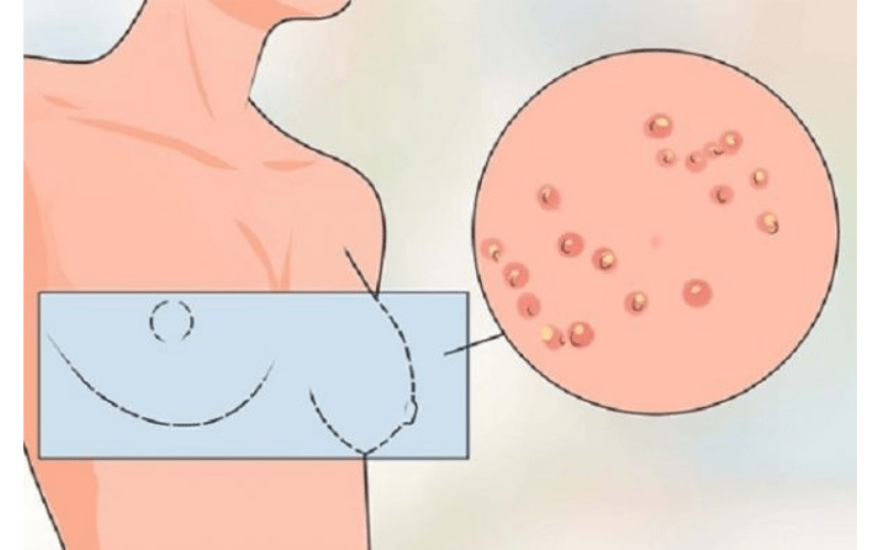 nhũ hoa dạng gồ ghề