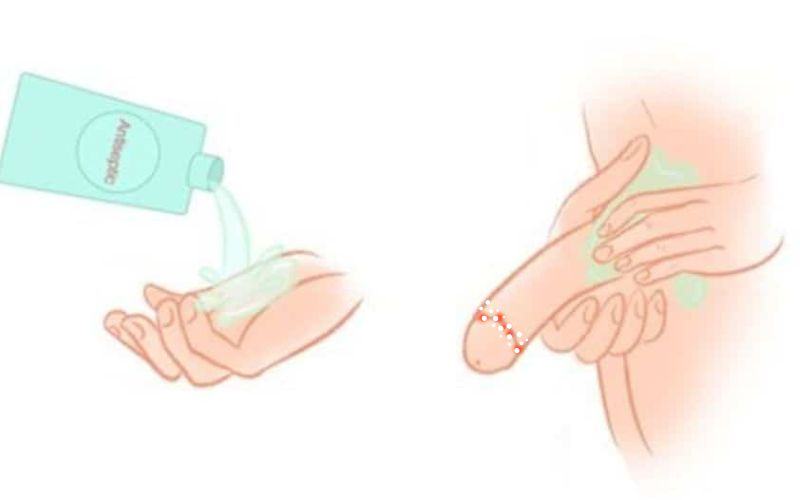 Nổi mụn trắng quanh bao quy đầu