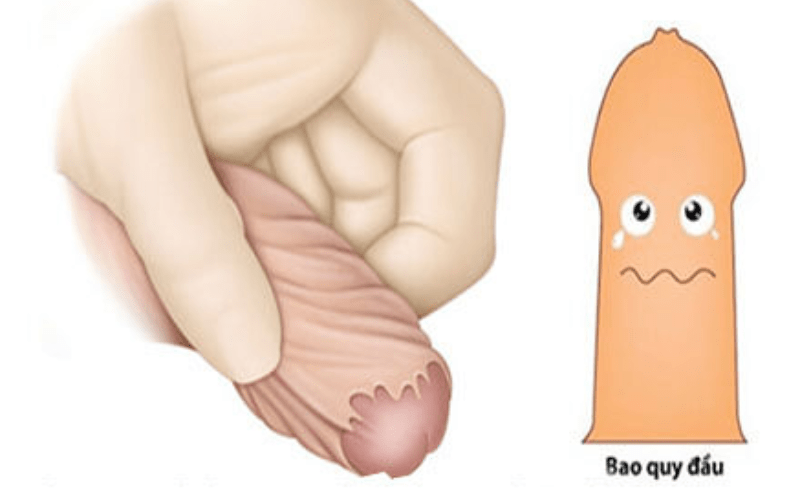 do bệnh lý dài, hẹp bao quy đầu
