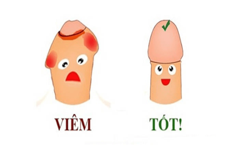 nổi mụn trắng ở bao quy đầu do viêm bao quy đầu