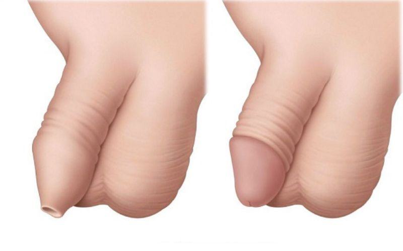 Cắt bao quy đầu bao lâu thì quan hệ được