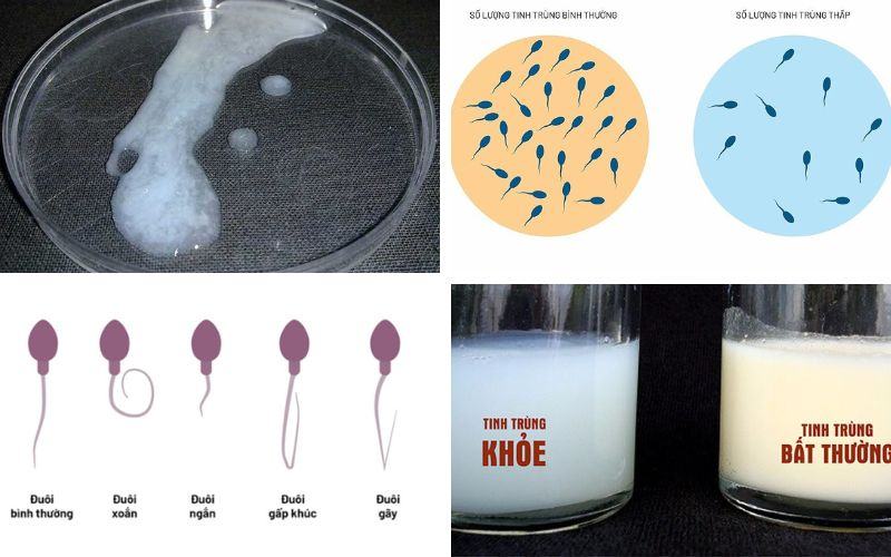 Hình ảnh tinh trùng bình thường