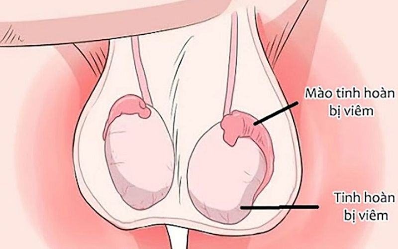 Tinh hoàn không đều