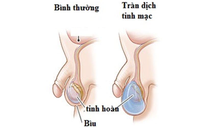 Nguyên nhân tinh hoàn không đều