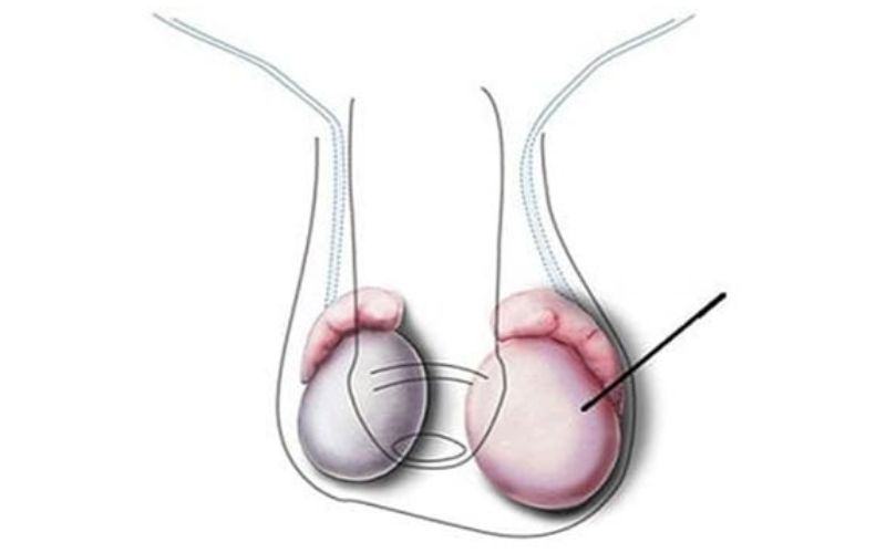 Nguyên nhân tinh hoàn bên lớn bên nhỏ